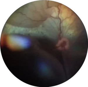 Retinal Detachment